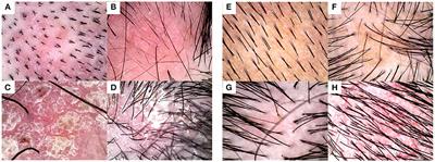 A deep learning-based approach toward differentiating scalp psoriasis and seborrheic dermatitis from dermoscopic images